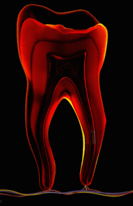 Root Canal