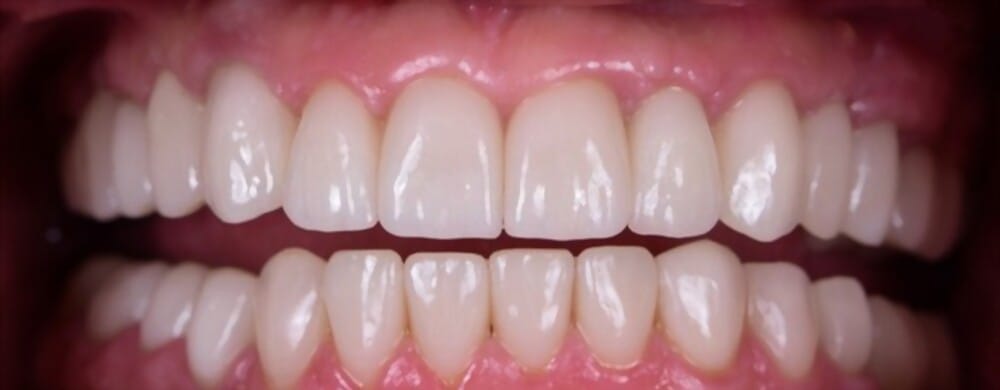 Full mouth dental implant