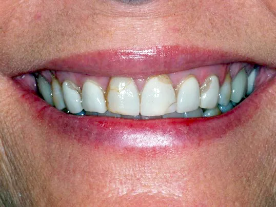 Teeth whitening-Before