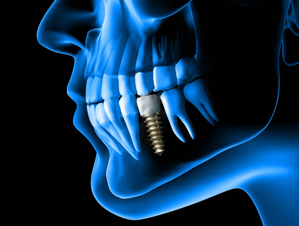 Implant Dentistry