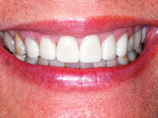 Teeth whitening-After