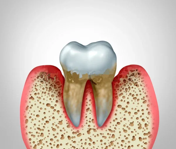 Periodontitis