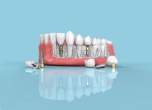 Dental Implant