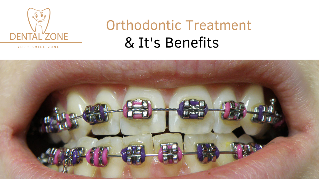 Orthodontic Treatment-Braces