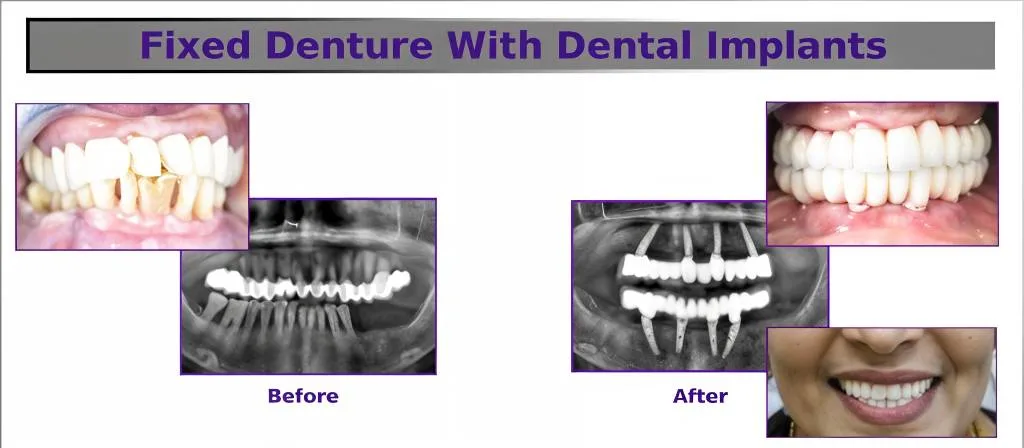 ALL ON 4 Dental Implants